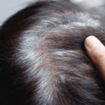 Effective Ayurvedic Treatments for Hair Loss and Early Greying