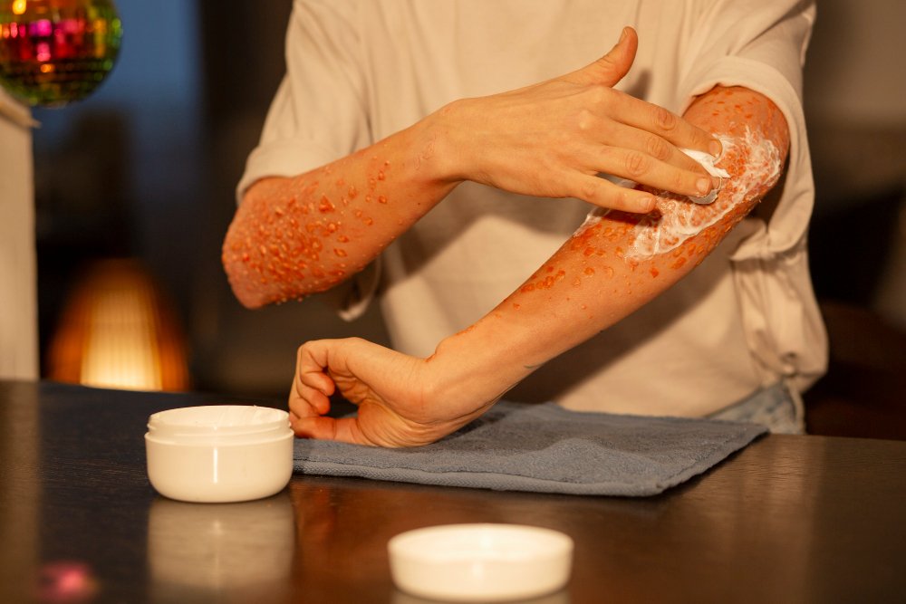Ayurvedic Treatment for Chickenpox