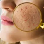 Fungal Acne Treatment in Ayurveda